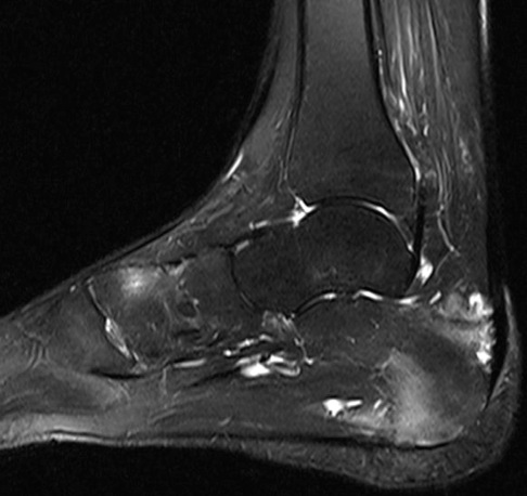 Figure 2 for case Ankylosing spondylitis ( RID3604 )